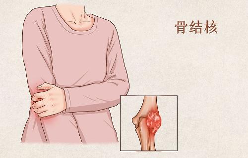 骨关节结核会传染吗？一文了解骨关节结核