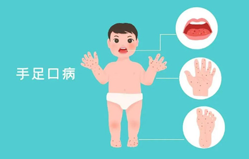 如何识别防治儿童手足口病