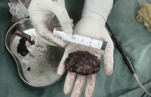 案例丨出血量仅100ml！91传媒
微创手术再升级